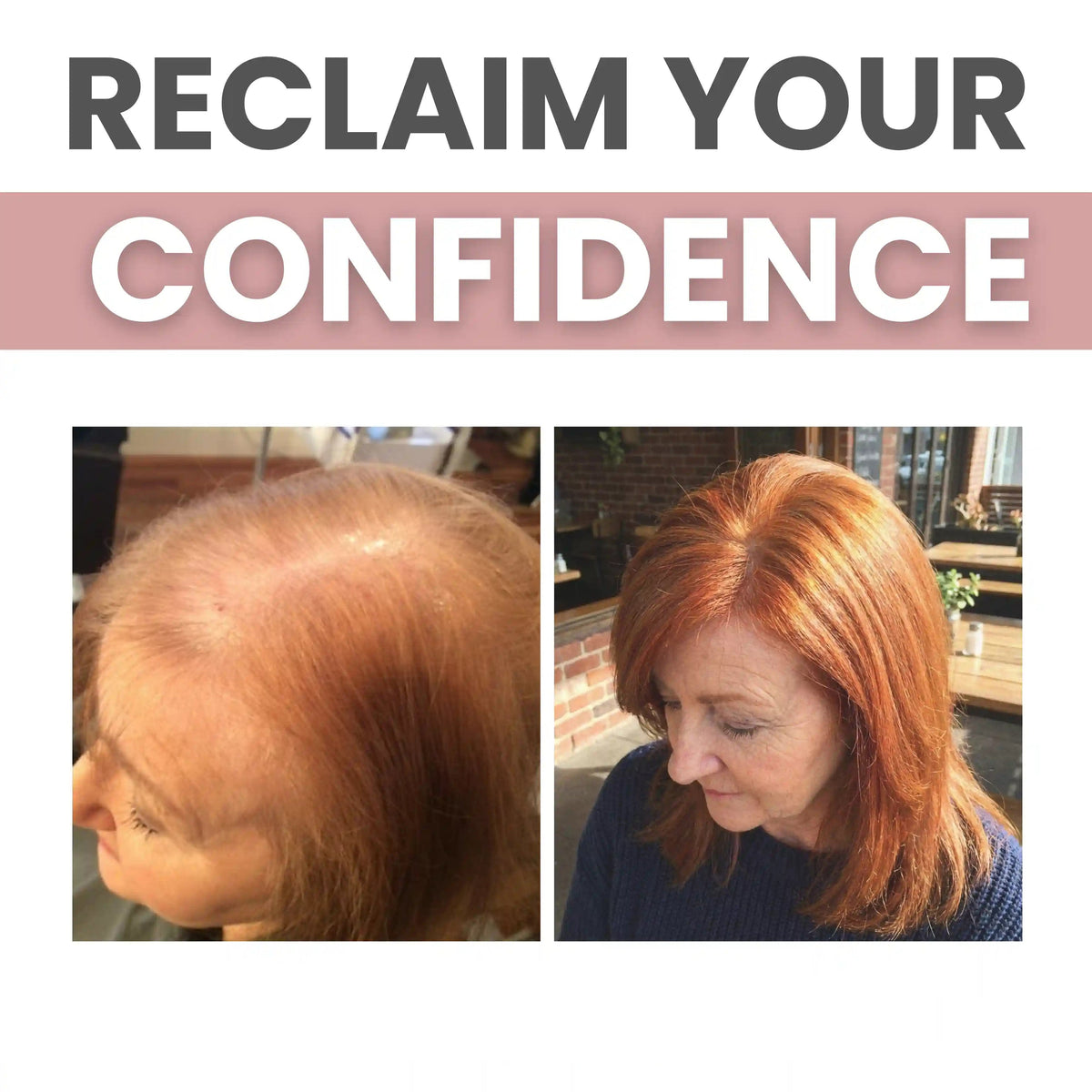 EXCLUSIVE DEAL 70% OFF🔥FoliGrow™ Advanced Dual-Peptide Hair Booster